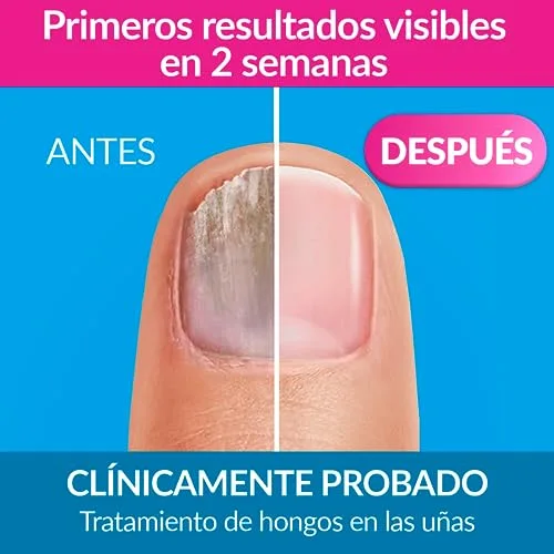Excilor ▫️ Tratamento da micose das unhas, Solução, Devolve a saúde e a beleza às unhas infetadas, Penetração rápida, Fácil aplicação com pincel, Clinicamente testado, 3,3 ml 3