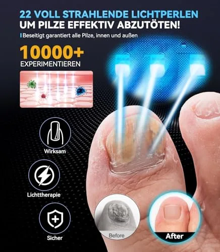 XSWCCJJ ▫️ Dispositivo a laser para fungos nas unhas 2026 【Tecnologia de comprimento de onda duplo – 470 nm azul e 905 nm infravermelho】【Modo inteligente de 3 tempos – 30 s/60 s/99 s】 Laser para fungos nas unhas vencedor do prémio 4